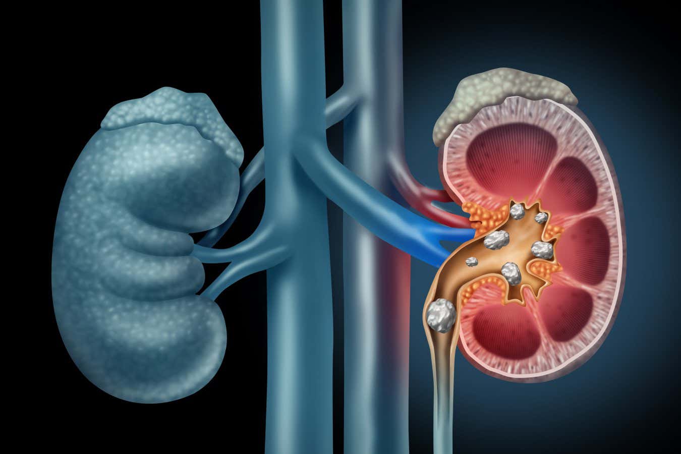 Magnetic gel could remove kidney stones more effectively